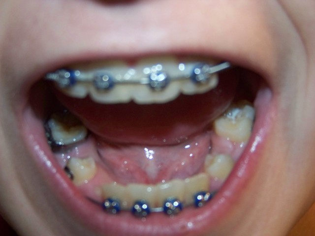 Braces