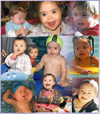 Calidad de vida de una persona con el sindrome.