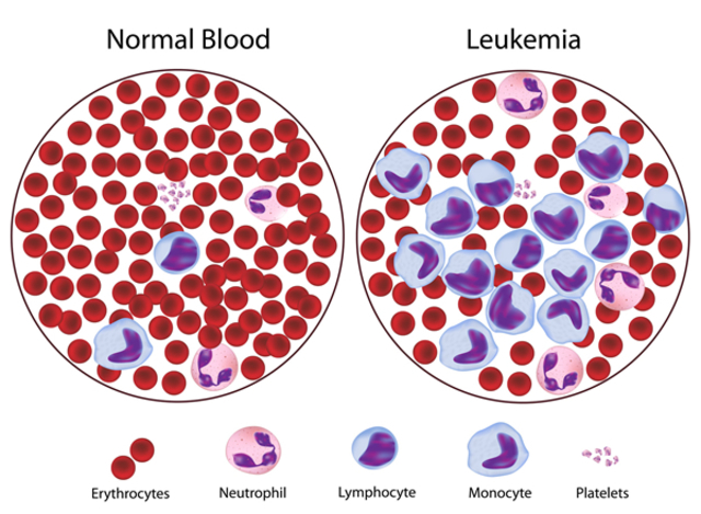 Researchers Link "Philadelphia Chromosome" To Leukemia