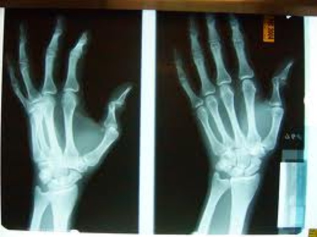 I broke another bone