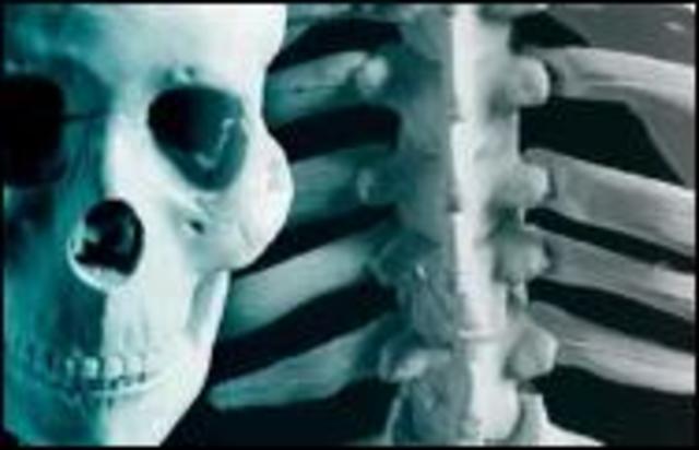 Crean huesos a medida usando calcio en polvo 2008