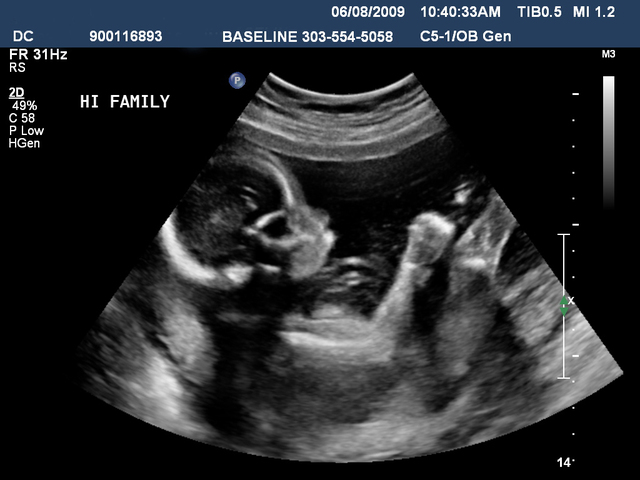 Ultrasonido (Ecografia)