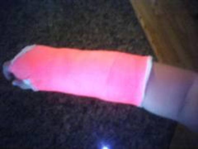 The First Time I Broke My Wrist
