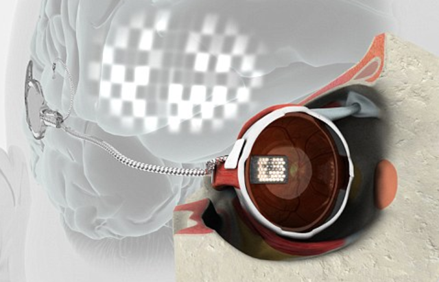 The Wide-View device