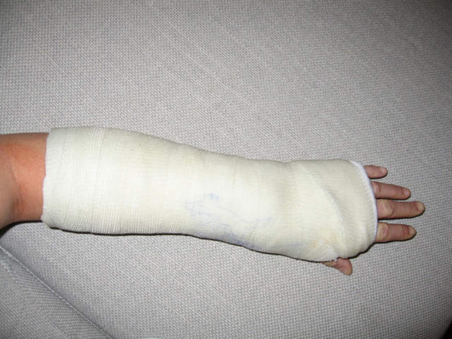 when i broke a kids arm