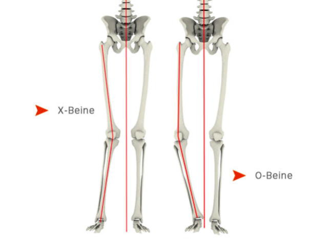 Knee Alignment Study