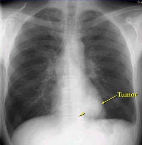 Lung X-Ray