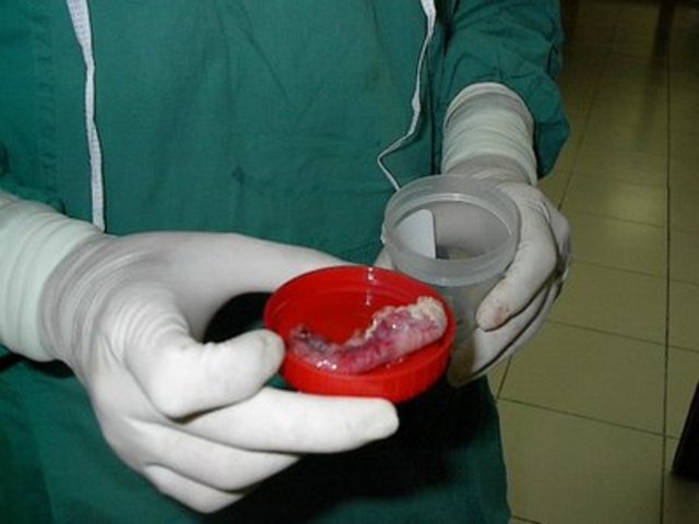 When I got my Appendix removed