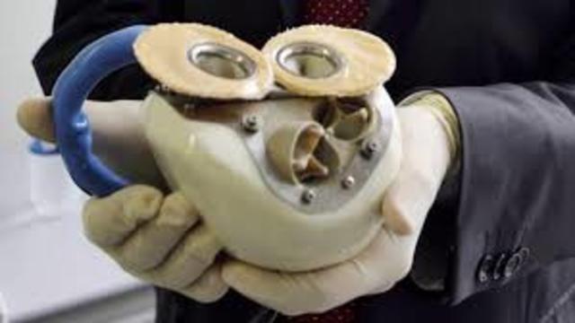 Primera implantación de un corazón artificial en un ser humano en París