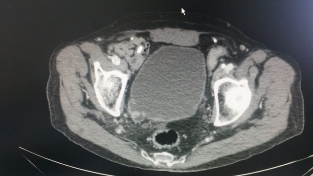 TAC abdomino-pélvico