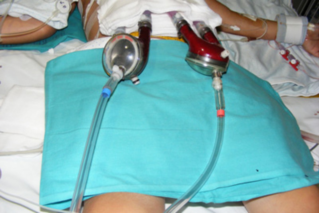 Primera persona que recibe un corazón artificial