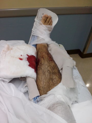 Fractura de tibia y peroné.