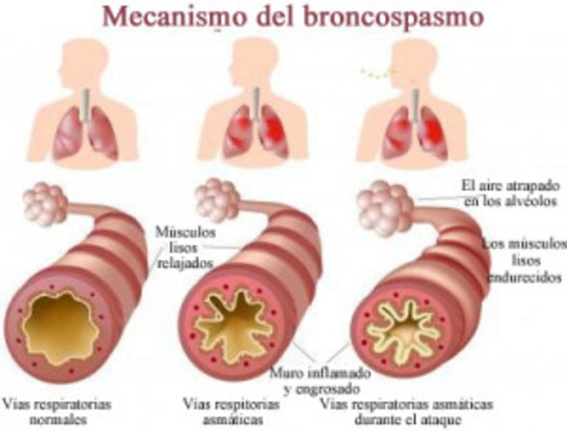 Hospitalización por bronco espasmo severo