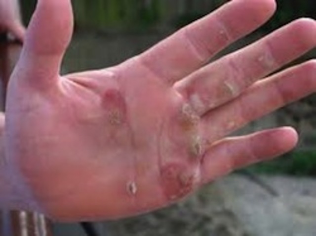 First Case of MRSA was Identified