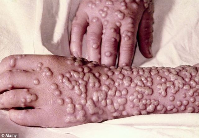 Smallpox Outbreak