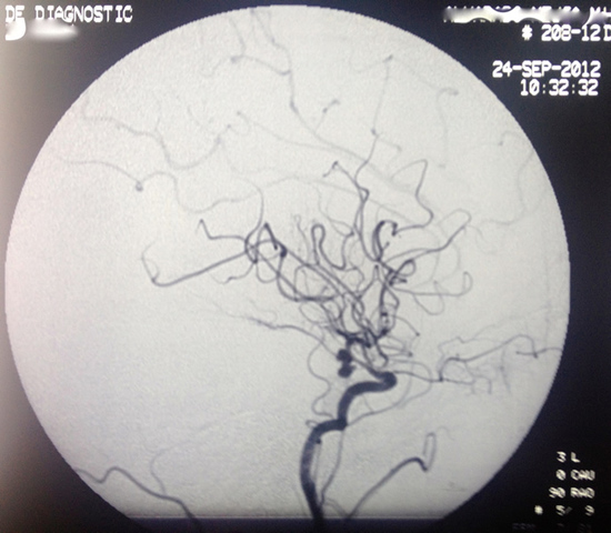 Investigación de tumores cerebrales