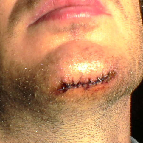 i got stiches,rating 0