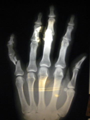 i broke my pinkie,rating 5