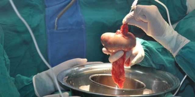 Trasplante de riñón