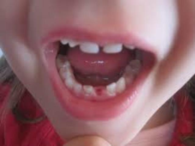 se me callo mi primer diente