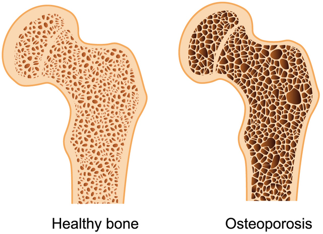 Bone Density Test