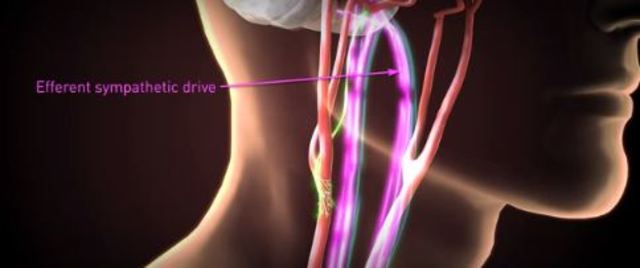 1ère implantation de stimulateur électrique des sinus carotidiens