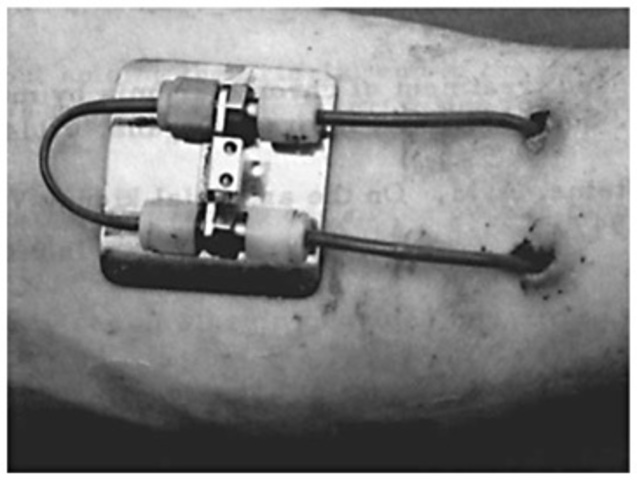 Teflon Dialysis shunts