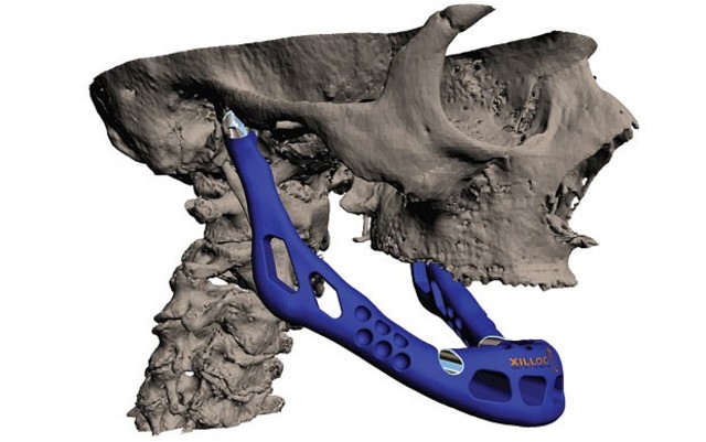 1st Prosthetic Jaw Implanted in Human