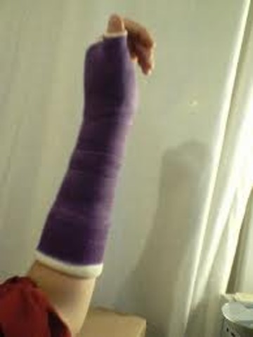 I broke my arm whle playing football on the first game of the season