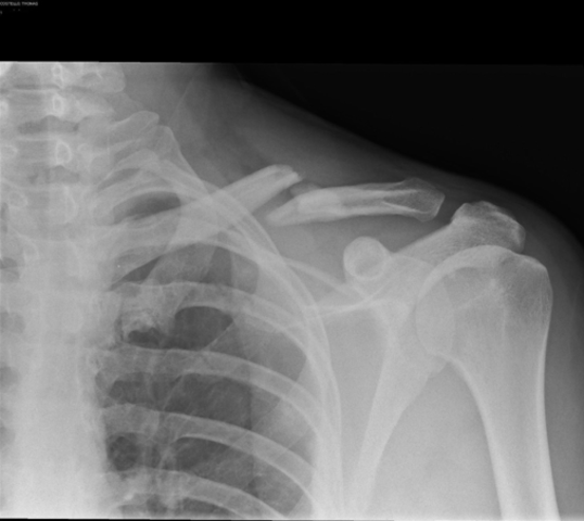 I cracked collar bone
