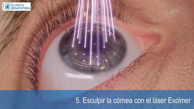 Cirugias con Laser