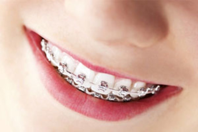 Cuando me pusieron brackets.