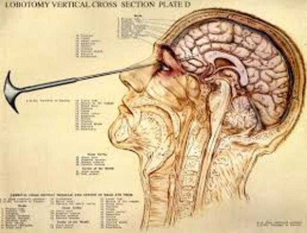 Lobotomy Comes to the United States