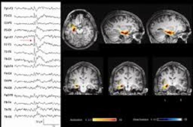 Epilepsy and the Functional Anatomy