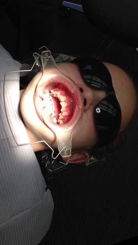I got Braces