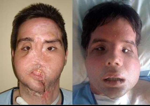 Trasplante de cara completa