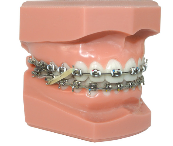 The day I got braces