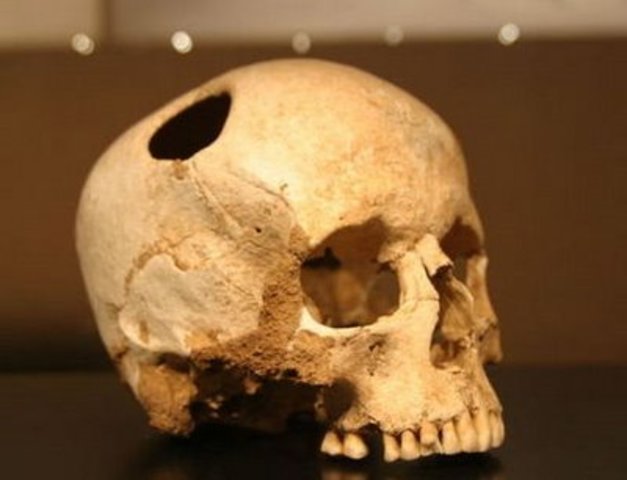 Trepanación