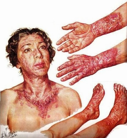 "SIGLO XX- LA PELAGRA"-----1901-2000 D.C