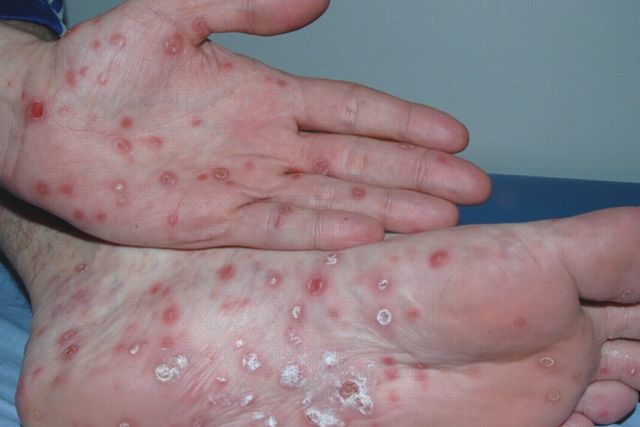 " LA SIFILIS VS LA PENICILINA"