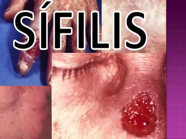 Pacientes afrodecendientes con sifils