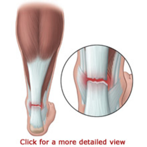 New Sport medicine advancements