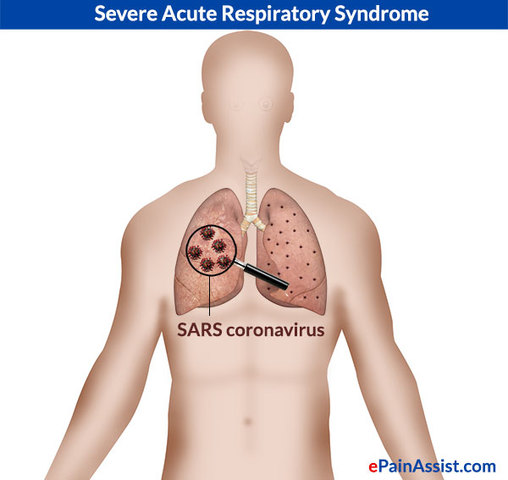 Severe Acute Respiratory System