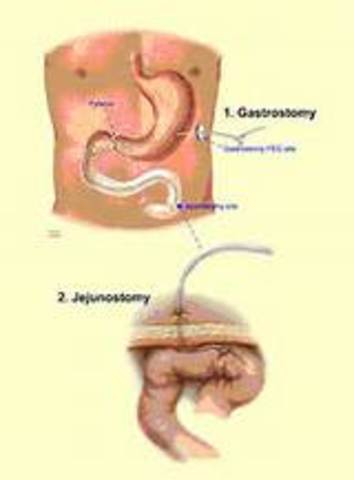 inicio de la alimentación oroyeyunal