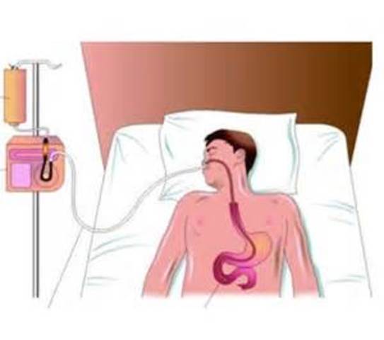 Alimentación Enteral
