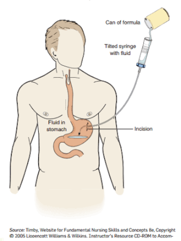 Se da más importancia al apoyo enteral que al parenteral