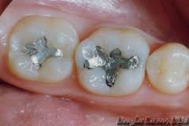 Tooth Fillings