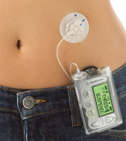 Insulin pump