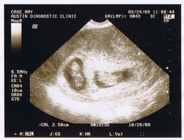 My Little sister Birth