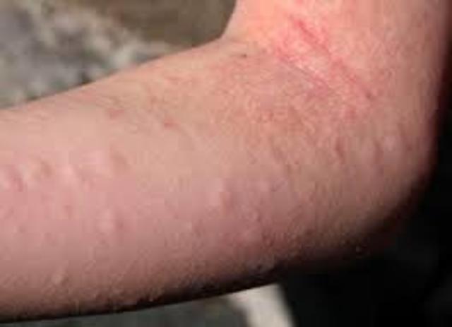 first alergic reaction